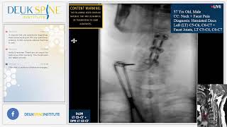 Deuk Plasma Rhizotomy DPR for Facet Joint Syndrome  C5C6 C6C7 [upl. by Ecirtak]