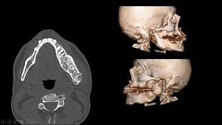 Displasia fibrosa [upl. by Terrej]