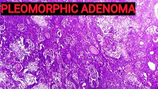 Benign Mixed Tumour of Salivary Gland  Pleomorphic Adenoma Histopathology [upl. by Aikrahs]