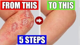 Transform Your Skin 5 Proven Psoriasis Remedies You Need to Try [upl. by Forelli]