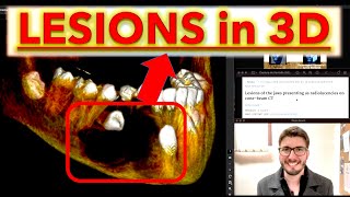 All Radiolucent Lesions with CBCT Periapical radiolucencies Cysts OKC Ameloblastoma lecture [upl. by Gelasias]