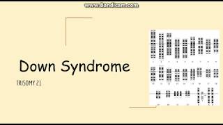 Trisomy 21 Down syn Genetics Pathology Clinical Symptoms and Diagnosis [upl. by Irollam490]