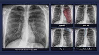 Simple Pneumothorax Explanation of Chest Xray Findings [upl. by Mart]