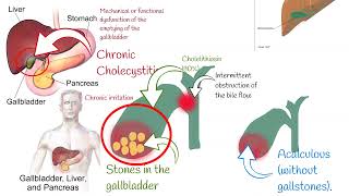 Cholecystitis Signs and symptoms Chronic and acute Cholecystitis biliary colic [upl. by Salvadore]