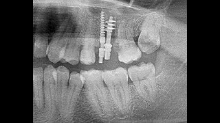 15th Discipline of basal implantology  Using Palatal socket of upper molar [upl. by Huntlee]