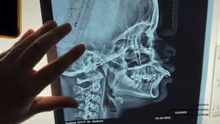 Demostration on Jarabaks Cephalometric Analysis  DrRasiga Gandhi  Department of Orthodontics [upl. by Irami503]