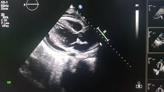 effuso constrictive pericarditis echocardiography [upl. by Idna]