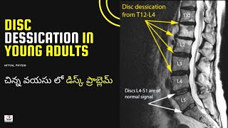 Disc Degeneration L5 S1 Disc Desiccation Disc Degeneration Causes DDDDegenerative Disc Treatment [upl. by Eenalem]