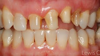 Canine tooth preparation for crown  drSuha ئامادەکردنی ددان بۆ دانانی کیف لەسەری [upl. by Tierney]