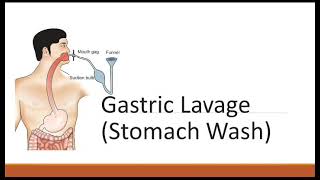 Gastric Lavage Stomach Wash [upl. by Napoleon]