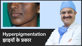 Types Of HyperpigmentationHyperpigmentation झाइयों के प्रकार Part 2 ClearSkin Pune  In HINDI [upl. by Orazio]