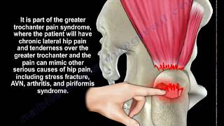 Gluteus Medius Tendon Tear  Everything You Need To Know  Dr Nabil Ebraheim [upl. by Wattenberg]