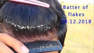 Extreme Dandruff scratching removal  Batter OF the Flakes 14122018 [upl. by Ollie]