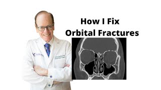 Orbital Fractures 101  Oculoplastic Surgeon Explains Orbital Fracture Surgery [upl. by Darby]