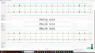 Voice Enabled Perio Charting amp PHI Reporting for ISO Standalone Denti AI Voice [upl. by Cohbert196]