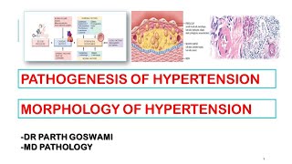 Hypertension  Pathogenesis  Morphology  Arteriosclerosis [upl. by Reinnej]