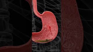 Gastric ulcers cause internal bleeding anatomypathologyshorts [upl. by Stanley]