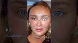 Scarless facelift and rhinoplasty by DrTAS drsuleymantas tasmedicalcenter scarlessfacelift [upl. by Lledyl141]