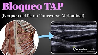 Bloqueo del Plano Transverso Abdominal TAP [upl. by Weingartner]