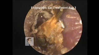 Ear wax removal fungus cleaning 🧹 20230803 [upl. by Anes]