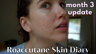 Roaccutane Daily Skin Diary  Month 3  The Purge Continues Low Dose  ft Temu Haul [upl. by Adeys470]