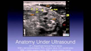 Tutorial Superficial Cervical Plexus Block [upl. by Omrellig]