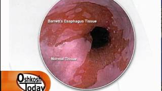 Barretts Esophagus [upl. by Philippine]