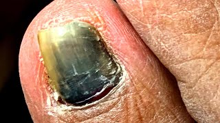 Debridement Of Black Nail On Diabetic Patient [upl. by Ielak]