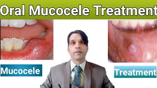 Mucocele  Homeopathic treatment for oral mucocele  Urdu  Hindi best homeopathic treatment [upl. by Yuu]