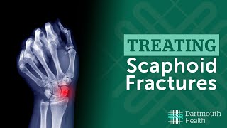 Treating Scaphoid Fractures at Dartmouth Health [upl. by Koorb]