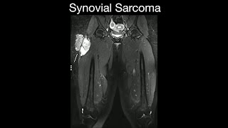 Synovial Sarcoma 1 [upl. by Hannavahs]