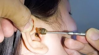 Removing One HUGE EARWAX Stuck in Womans Ear [upl. by Ahsinawt]