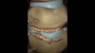 Cervical discectomy  animationshorts shortsfeed youtubeshorts viralshorts [upl. by Eirlav]