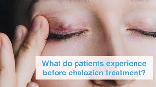 What do patients experience before chalazion treatment [upl. by Claudy]