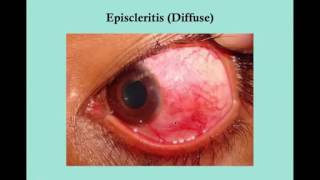 Scleritis and Episcleritis CRASH USMLE Step 2 and 3 [upl. by Nibot]