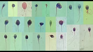 Semen Analysis Test Lab  Sperm Morphology [upl. by Dnomsaj]