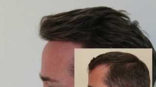 Hair Transplant Turkey Dense Packing Hairline Hairline Clinic [upl. by Slerahc]