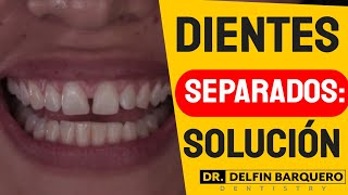 Dientes separados solución con carillas dentales en Costa Rica [upl. by Alleynad]