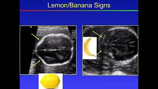 Fetal Congenital anomalies part 1 [upl. by Arly332]