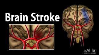 Brain Stroke Types of Causes Pathology Symptoms Treatment and Prevention Animation [upl. by Wein]