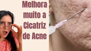 4 Tratamentos eficazes para CICATRIZ DE ACNE [upl. by Aneerbas279]