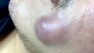 Big infected cyst Cisto infeccionado Enjoy the best videos of blackheads cravos gigantes pimple [upl. by Kay983]