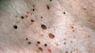 Difference Between Skin Tags and Warts [upl. by Sudderth]