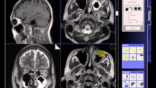 BRAIN MRI IN CASE SINUSITIS BILATERAL [upl. by Dweck]