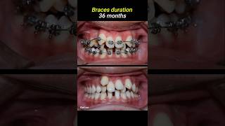 Braces for crowded teeth braces orthodontist dentistry dentist [upl. by Ban24]