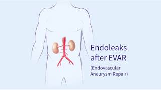 Endoleaks after Endovascular Repair of Thoracic Aortic Aneurysms EVAR [upl. by Adelaida]