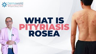 Skin Rash Pityriasis Rosea Hai  Symptoms Aur Treatment Explained  dermaworldskinclinics [upl. by Bael524]