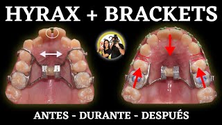 Proceso 𝗠𝗘𝗦 𝗮 𝗠𝗘𝗦  HYRAX  BRACKETS  Tratamiento ORTODONCIA [upl. by Glantz]