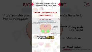 Cleft Lip and Palate Explained [upl. by Braswell467]