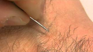 How to remove an ingrown hair [upl. by Lyrehs]